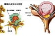 腰椎间盘突出