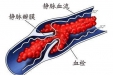 下肢深静脉血栓