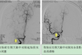 急性缺血性卒中大血管栓塞血管再通治疗（动脉取栓治疗）