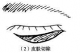 睑内翻矫正术