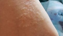 摩擦性苔藓样疹