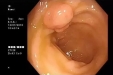肠息肉种类可不少，读懂肠镜（病理）报告很重要！
