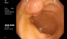 肠息肉种类可不少，读懂肠镜（病理）报告很重要！