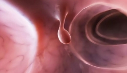 我叫“息肉”，息肉真的都容易变成癌吗？