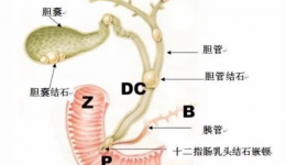 急性胆囊炎的保守治疗