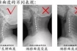 康复科医生教你如何选择枕头保护颈椎？