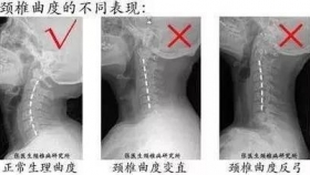 康復(fù)科醫(yī)生教你如何選擇枕頭保護(hù)頸椎,？