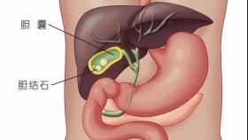 膽囊結(jié)石怎么辦,？肝膽外科醫(yī)生告訴你答案