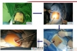 首次 | 胸外科这种方式实现全胸腺切除 开创先河！