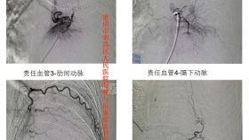 罕見(jiàn) | 一患者左側(cè)胸腔巨大占位伴大咯血 呼吸與重癥醫(yī)學(xué)科采取血管介入+氣道介入助其化險(xiǎn)為夷