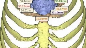 高精尖 | 罕見腫瘤“吞噬”胸骨柄 3D打印成形的鈦網(wǎng)人工胸骨幫其實現(xiàn)胸廓重建...