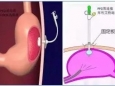 助力三甲 | 區(qū)人民醫(yī)院完成首例CT引導(dǎo)下經(jīng)皮胃造瘺術(shù)