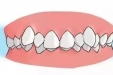 单颌矫正VS双颌矫正