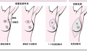 乳腺癌保乳手術(shù)