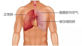 氣胸，一種會呼吸的痛,！