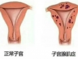 警惕,！女子肚子大似懷孕4個(gè)月，一直痛經(jīng),，兇手竟然是...