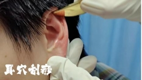 耳穴综合疗法 | 小耳朵里的大健康，五法联动解锁中医智慧！