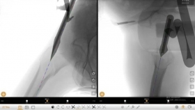 荣昌区人民医院谭响团队斩获省部级科研项目！数智化骨科导航系统开启创伤诊疗新纪元